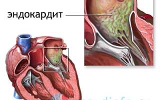 Эндокардит: причины и развитие, симптомы, диагностика, терапия различных видов