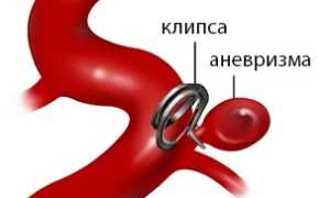 Клипирование аневризмы головного мозга: показания, проведение, альтернативы, реабилитация