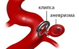 Клипирование аневризмы головного мозга: показания, проведение, альтернативы, реабилитация
