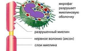 Демиелинизация: понятие, как развивается, обзор демиелинизирующих заболеваний, лечение