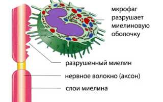 Демиелинизация: понятие, как развивается, обзор демиелинизирующих заболеваний, лечение