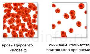 Анемия: причины и виды, признаки и проявления, как лечить