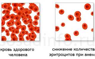 Анемия: причины и виды, признаки и проявления, как лечить