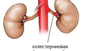 Инфаркт почки: возникновение, виды, признаки и проявления, диагностика, как лечить