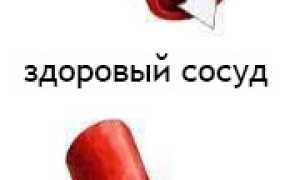 Спазм сосудов: в руках, ногах, сердца (коронарных артерий)