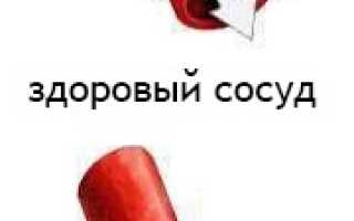 Спазм сосудов: в руках, ногах, сердца (коронарных артерий)