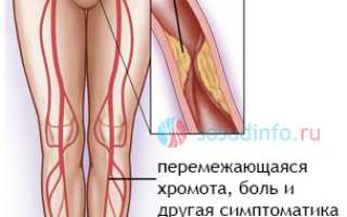 Синдром Лериша: причины и развитие, течение, диагностика, принципы лечения