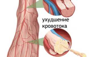 Синдром диабетической стопы: понятие, признаки, как выглядит, развитие, чем лечить