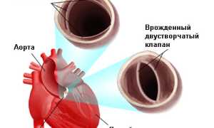 Аортальный стеноз (устья аорты): причины и развитие, симптоматика, как лечить, прогноз