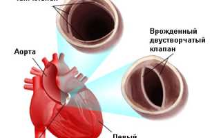 Аортальный стеноз (устья аорты): причины и развитие, симптоматика, как лечить, прогноз