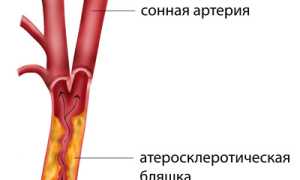 Стеноз (сужение) сонных артерий: как развивается, признаки и степени, лечение