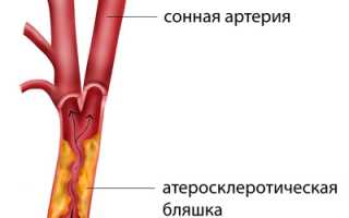 Стеноз (сужение) сонных артерий: как развивается, признаки и степени, лечение