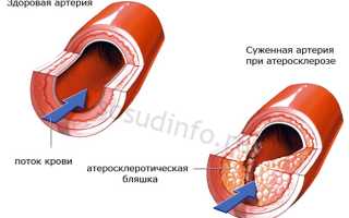 Склероз артерий головного мозга: признаки, диагностика, методы лечения