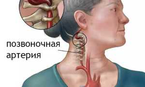 Синдром позвоночной артерии: понятие, признаки, лечение, группы риска