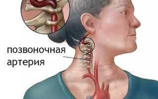 Синдром позвоночной артерии: понятие, признаки, лечение, группы риска