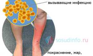 Рожистое воспаление: причины, проявления, признаки, методы лечения