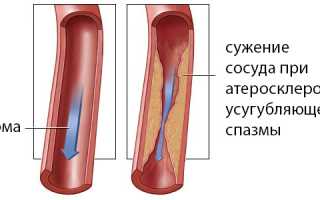 Ангиоспазм: причины, симптомы и локализации, лечение, последствия