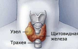 Какие причины провоцируют узловой зоб щитовидной железы 2 степени, основные симптомы и методы лечения?