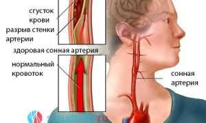 Аневризма сонной артерии: причины, виды, признаки, диагностика, операция, прогноз