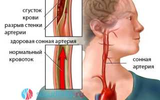 Аневризма сонной артерии: причины, виды, признаки, диагностика, операция, прогноз