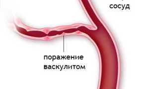 Болезнь Бехчета: причины, признаки, диагностика, как лечить