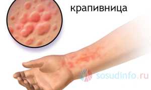 Крапивница: виды, проявления, диагностика, лечение, профилактика