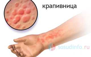 Крапивница: виды, проявления, диагностика, лечение, профилактика