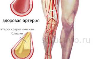 Перемежающаяся хромота (ПХ): возникновение, симптомы, диагностика, лечение, осложнения