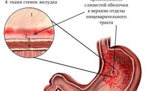 Геморрагический гастрит: причины и особенности, проявления, диагностика, лечение, прогноз