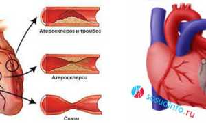 Грудная жаба: причины, признаки, диагноз, лечение, прогноз