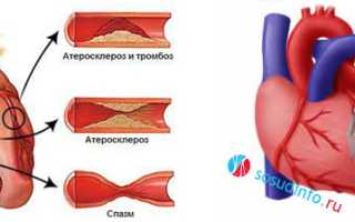 Грудная жаба: причины, признаки, диагноз, лечение, прогноз