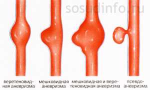 Аневризма сосудов мозга: причины, признаки, последствия, операция