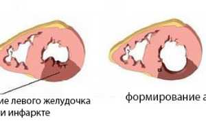Аневризма левого желудочка: причины, симптомы, диагностика, лечение, прогноз