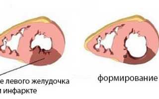 Аневризма левого желудочка: причины, симптомы, диагностика, лечение, прогноз