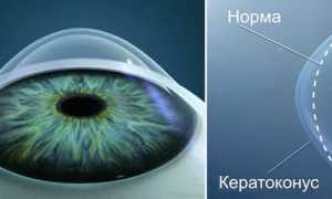 Что такое кератоконус глаз: причины, симптомы и возможные методы лечения