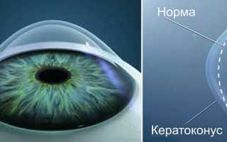 Что такое кератоконус глаз: причины, симптомы и возможные методы лечения