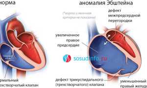 Аномалия Эбштейна: понятие, клиника, диагностика, лечение, прогноз
