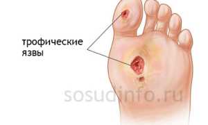 Трофические язвы: классификация, профессиональное и народное лечение