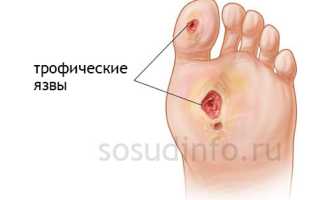 Трофические язвы: классификация, профессиональное и народное лечение