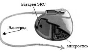 Кардиостимулятор: виды, показания, операция по установке, жизнь с ЭКС, прогноз