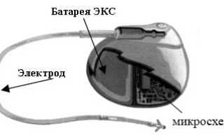 Кардиостимулятор: виды, показания, операция по установке, жизнь с ЭКС, прогноз