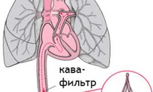 Кава-фильтр в нижнюю полую вену: что это, имплантация, кому показан