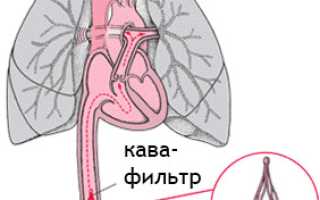 Кава-фильтр в нижнюю полую вену: что это, имплантация, кому показан