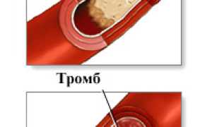 Склероз аорты: причины, симптомы, формы, как лечить, профилактика