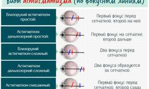 Берут ли в армию с астигматизмом? Причины и диагностика заболевания