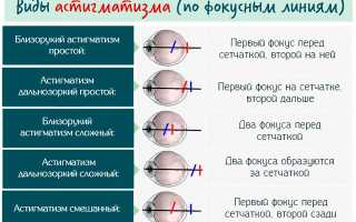 Берут ли в армию с астигматизмом? Причины и диагностика заболевания