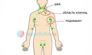 Лимфома: определение, типы, развитие, течение, диагностика, терапия, прогноз