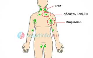 Лимфома: определение, типы, развитие, течение, диагностика, терапия, прогноз