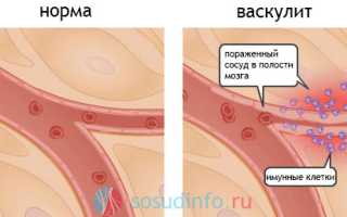 Геморрагические васкулиты: причины и развитие, формы, симптоматика, диагностика, лечение