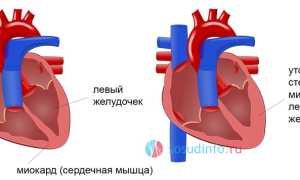 Спортивное сердце (синдром сердца спортсмена): развитие, симптомы, диагностика, чем грозит